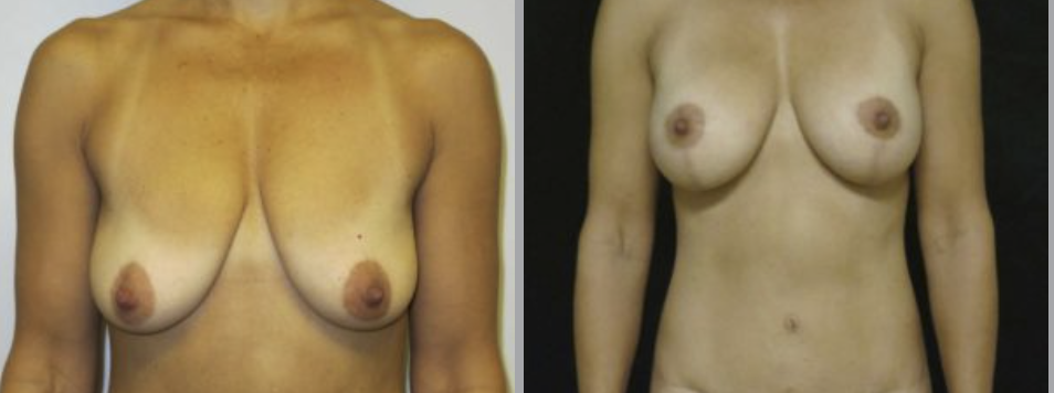 Breast Lift in Ventura, CA
